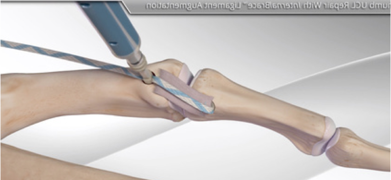 Thumb MCP Joint Ulnar Collateral Ligament Reconstruction Thomas R