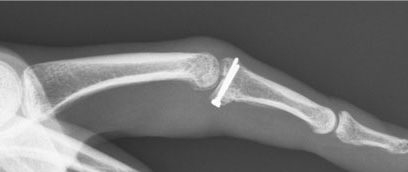 Phalangeal Fracture Dislocation
