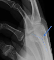 lateral X-ray showing angulation at the fracture site