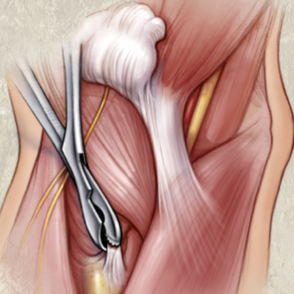 Distal Biceps Repair tuberosity