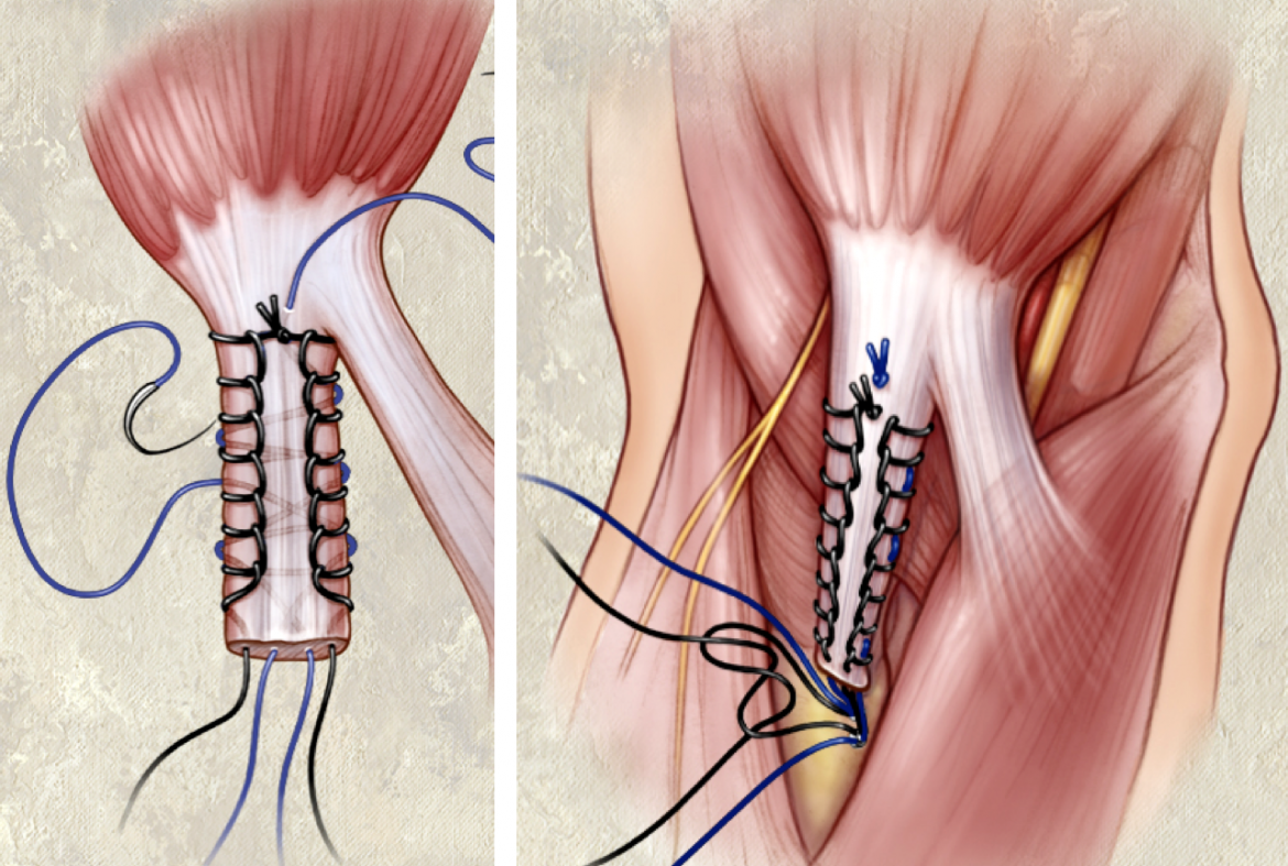 1215 130 PM General LMA Anesthesia with PostOperative LongActing