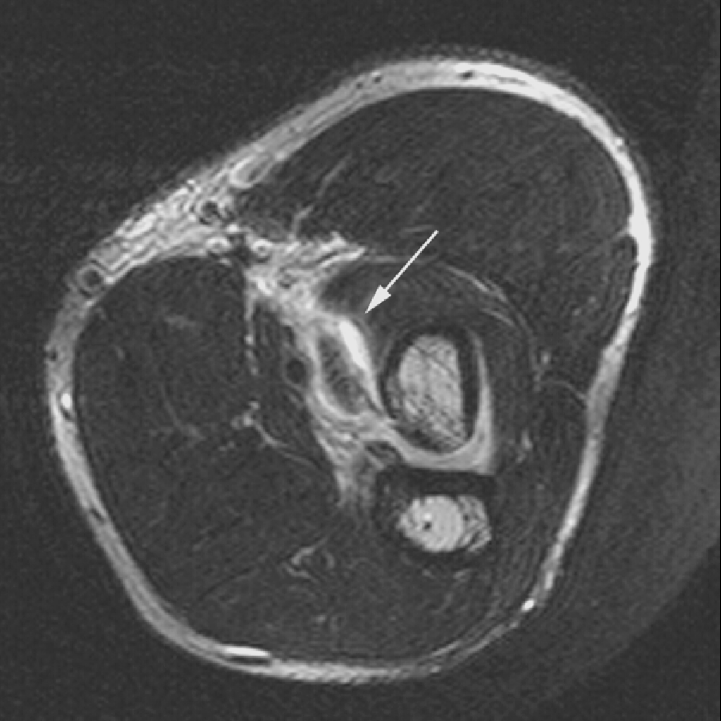 Distal Biceps Repair MRI