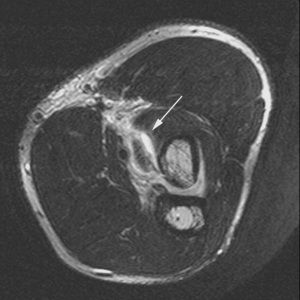 Distal Biceps Repair - Thomas R. Hunt III, M.D., D.Sc.