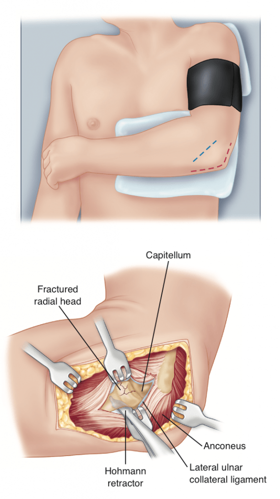 Lateral incision to expose fracture