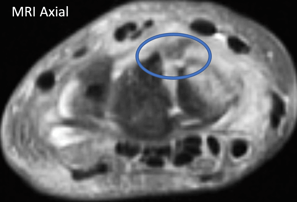 MRI axial