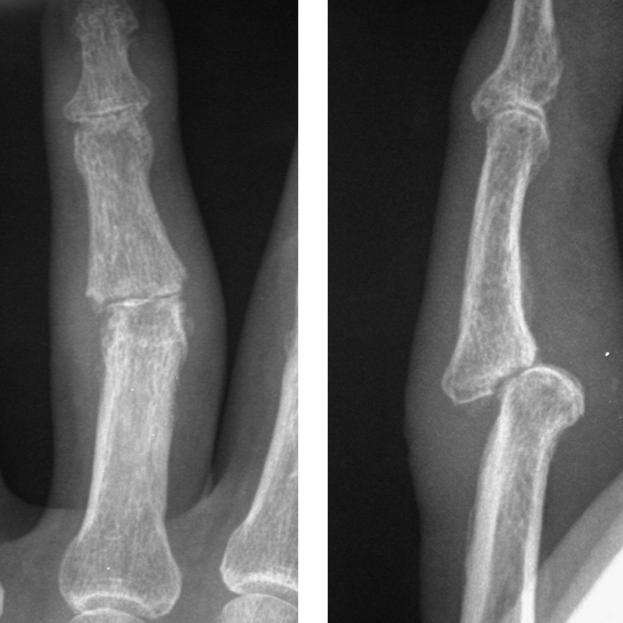 PIP Joint Pyrocarbon Implant Arthroplasty - Thomas R. Hunt III, M.D., D.Sc.