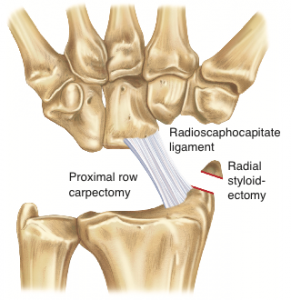 Proximal Row Carpectomy - Thomas R. Hunt III, M.D., D.Sc.