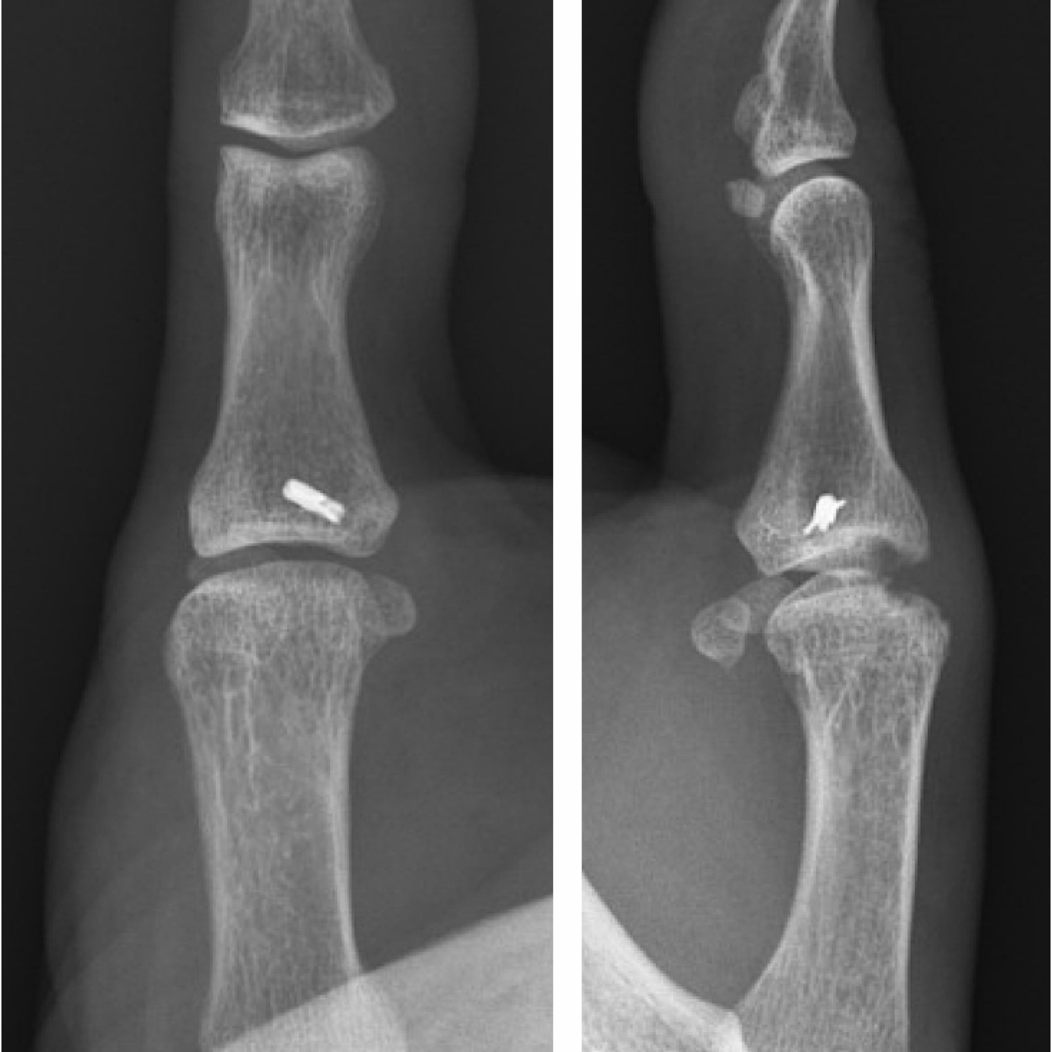 Thumb MCP Joint Fusion - Thomas R. Hunt III, M.D., D.Sc.