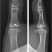 Thumb Mcp Joint Fusion Thomas R Hunt Iii M D D Sc Thumb Mcp Joint Fusion Thomas R Hunt Iii M D D Sc
