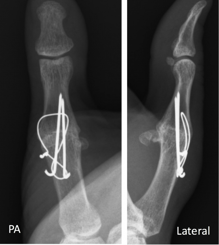 Thumb MCP Joint Fusion - Thomas R. Hunt III, M.D., D.Sc.