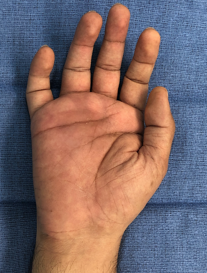 excruciating pain in right palm