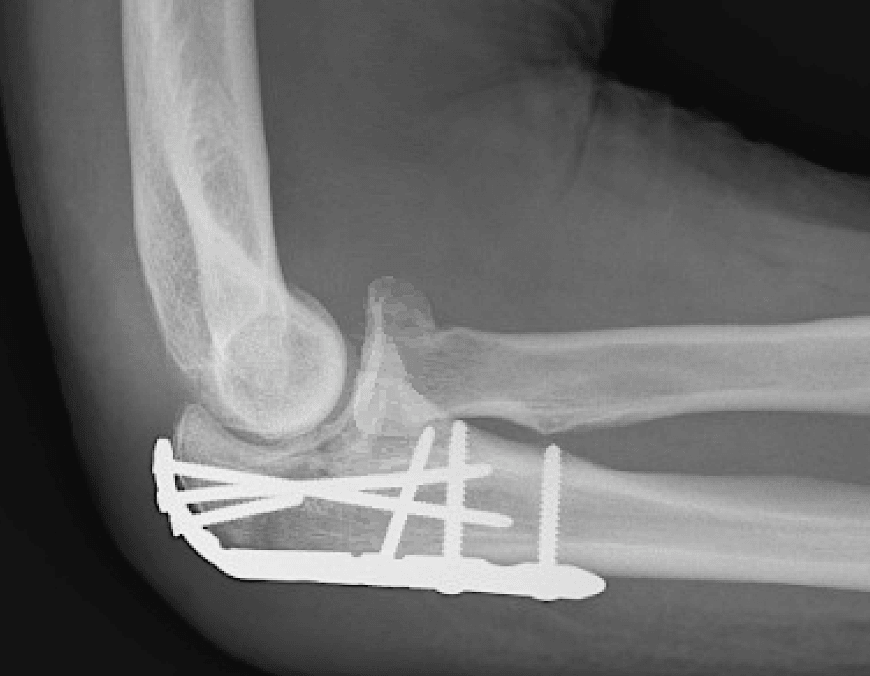 fracture stabilized with plate and screw construct