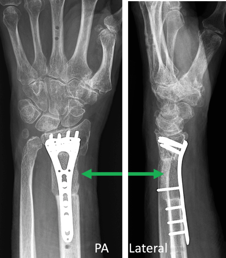 Open Reduction Internal Fixation and Bone Grafting Distal Radius
