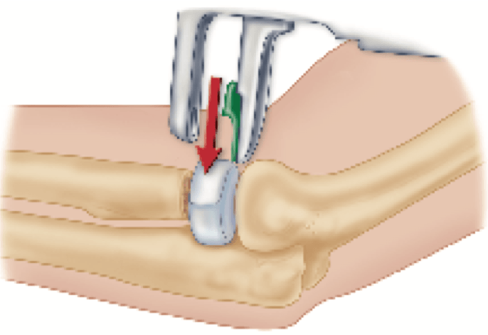 placement of implant