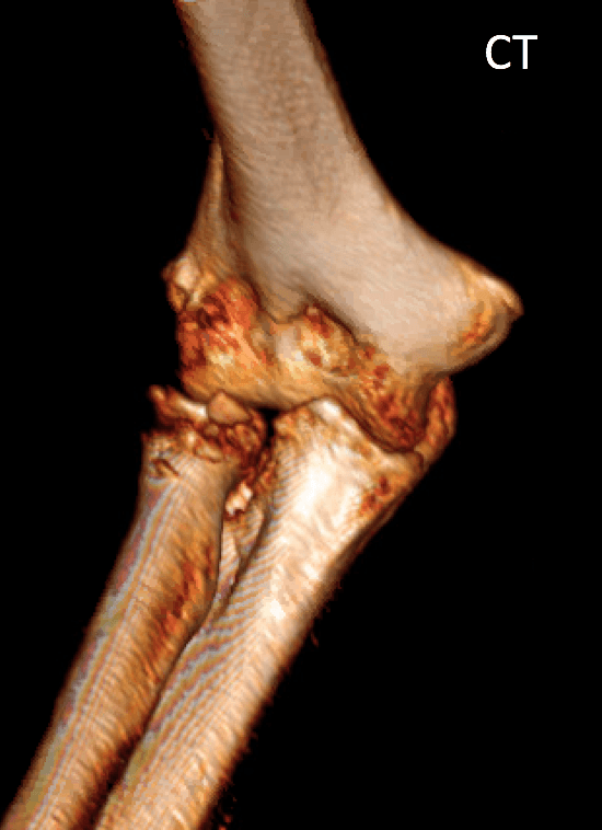 radial head fracture and non-displaced coronoid fracture