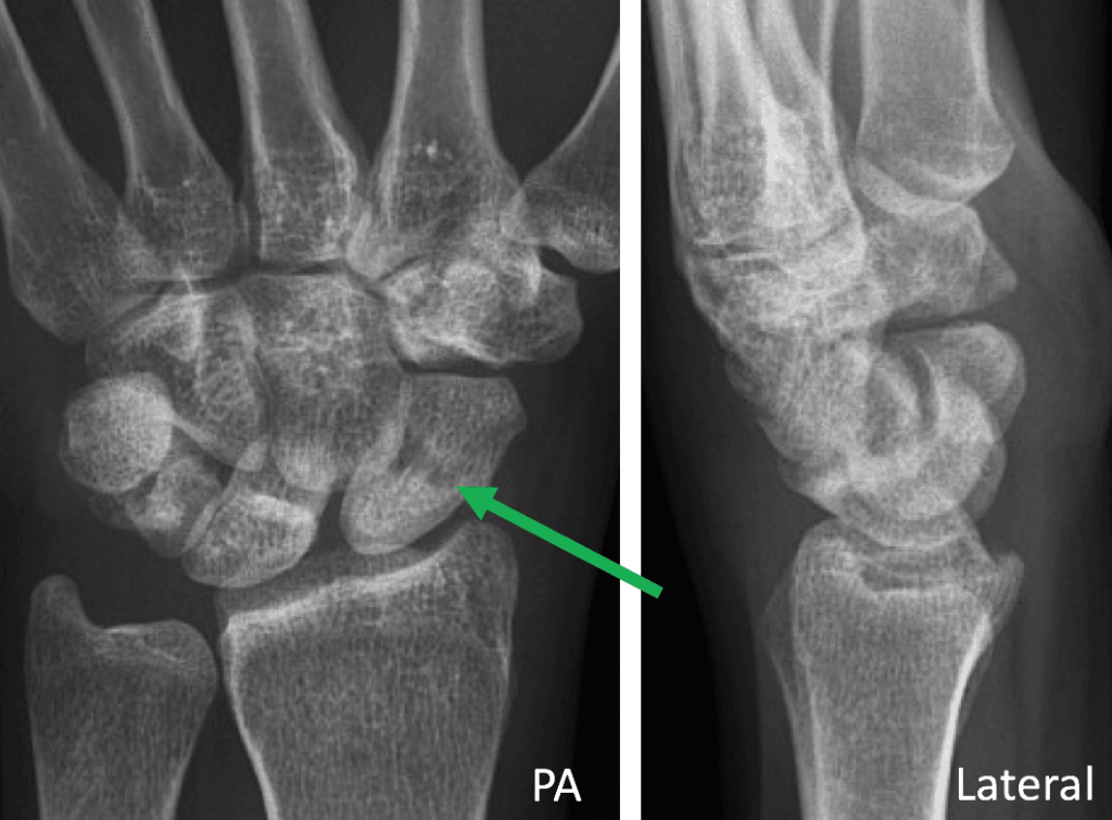 scaphoid fracture x rays