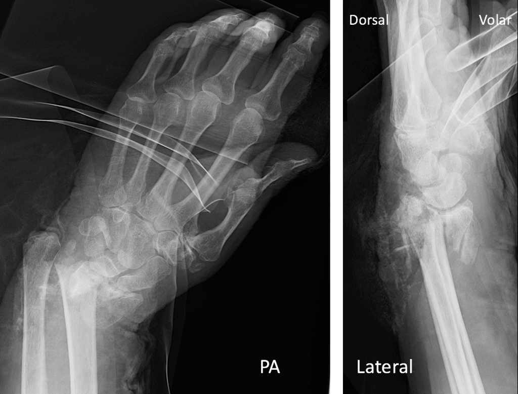 severe-comminution-and-deformity-involving-the-distal-radius-and-ulna-metaphysis-and-joint