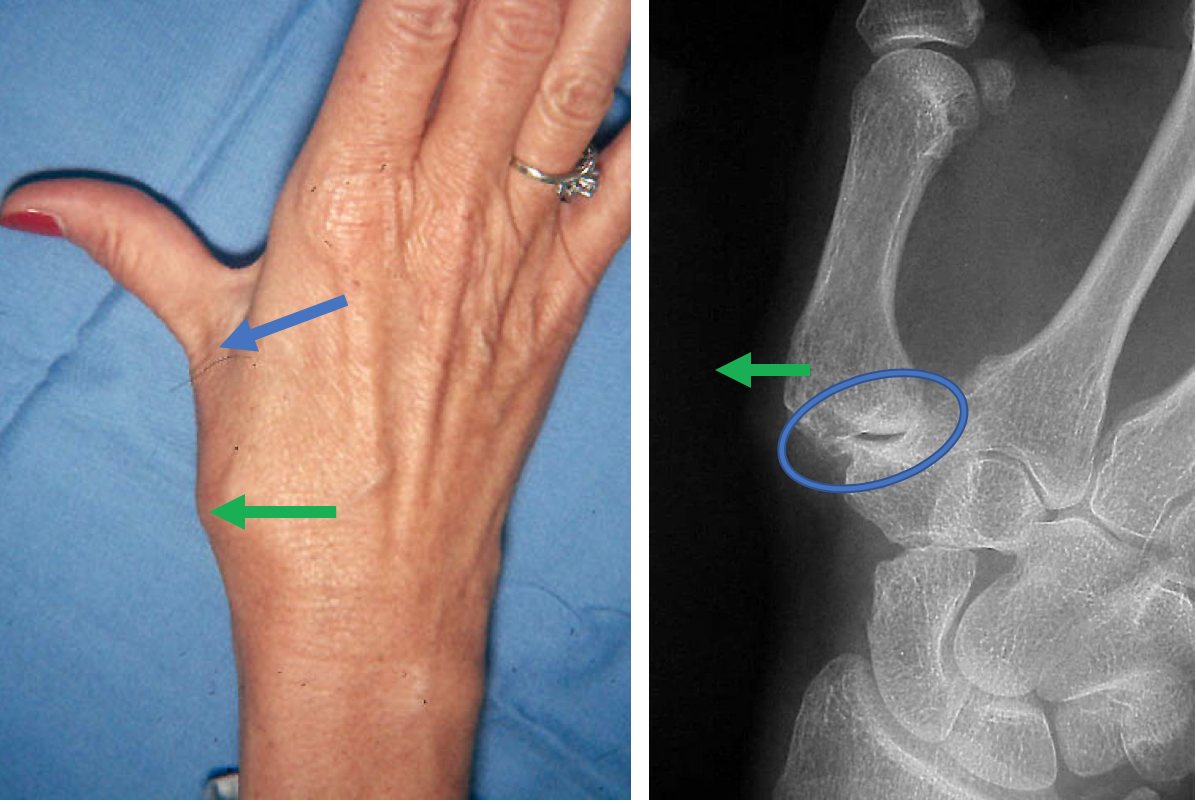 Tendon Suspension Arthoplasty Thomas R. Hunt III, M.D., D.Sc.