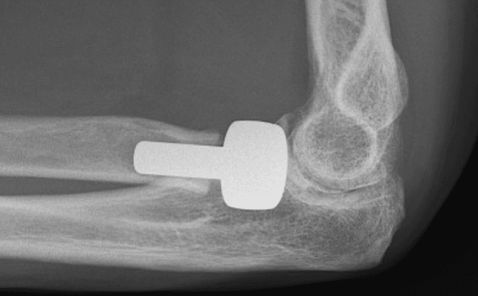 x-ray showing implant